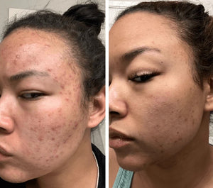 Omnilux Clear Mask