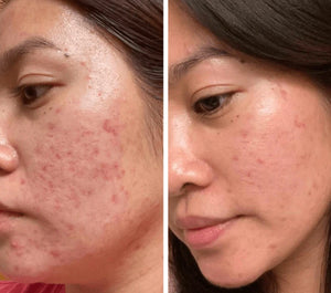 Omnilux Clear Mask